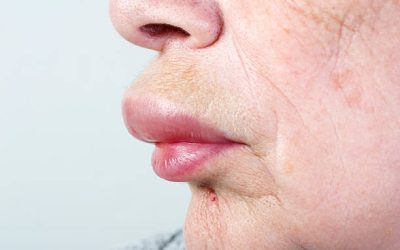 [AFBLIJVEN] Tropische allergie, of koemelk moet je lijf nie. De #1 onderliggende oorzaak voor allergieën